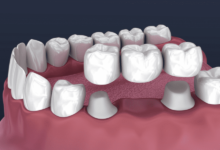 dental-cap-vs-crown:-what’s-the-difference?