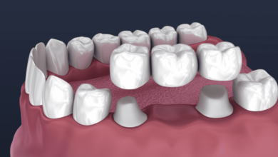 dental-cap-vs-crown:-what’s-the-difference?