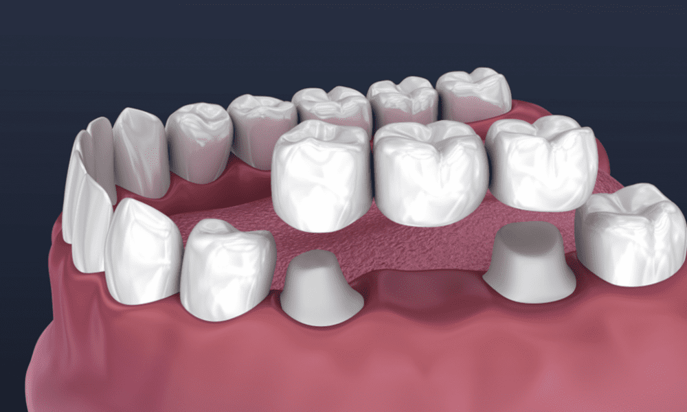 dental-cap-vs-crown:-what’s-the-difference?