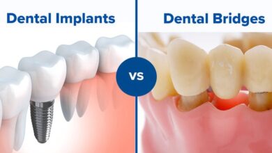 dental-implants-vs.-bridges-in-georgetown:-what’s-the-difference?