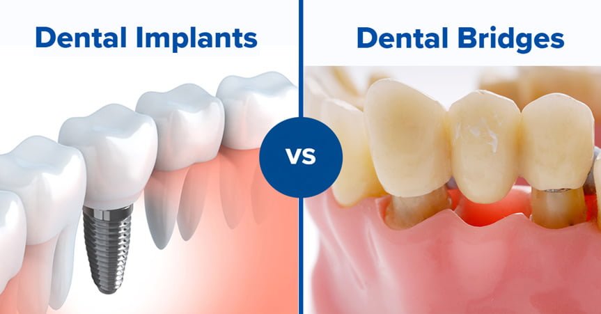 dental-implants-vs.-bridges-in-georgetown:-what’s-the-difference?